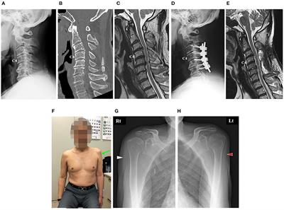 Robotic Shoulder Rehabilitation With the Hybrid Assistive Limb in a Patient With Delayed Recovery After Postoperative C5 Palsy: A Case Report